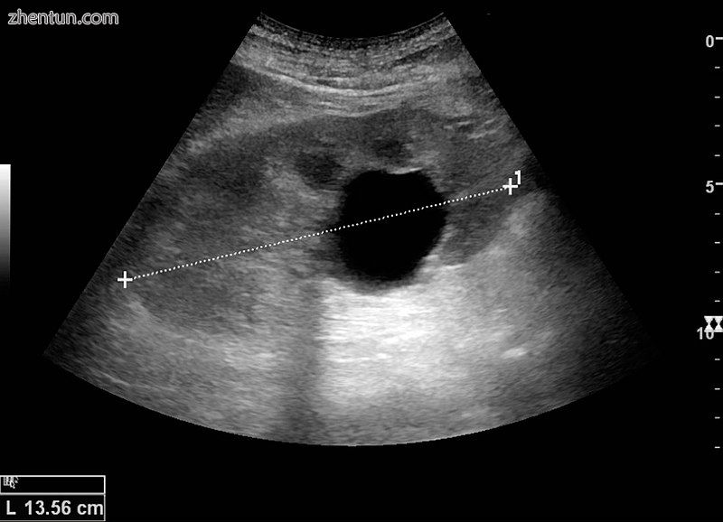 Renal ultrasonography of a simple renal cyst with posterior enhancement i.jpg