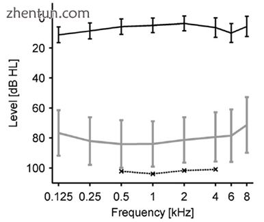 Loudness discomfort levels (LDLs) data of people with hyperacusis without hearing.jpg