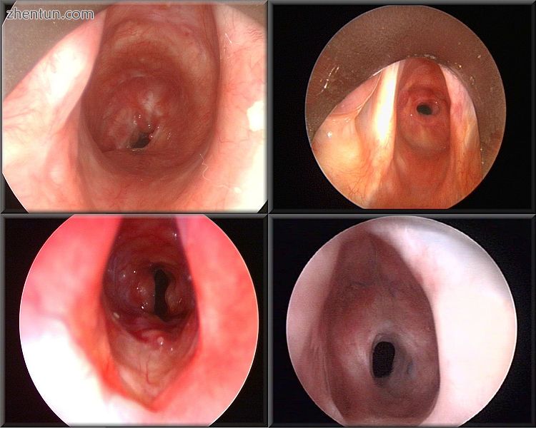 This condition can also be referred to as subglottic or tracheal stenosis..jpg