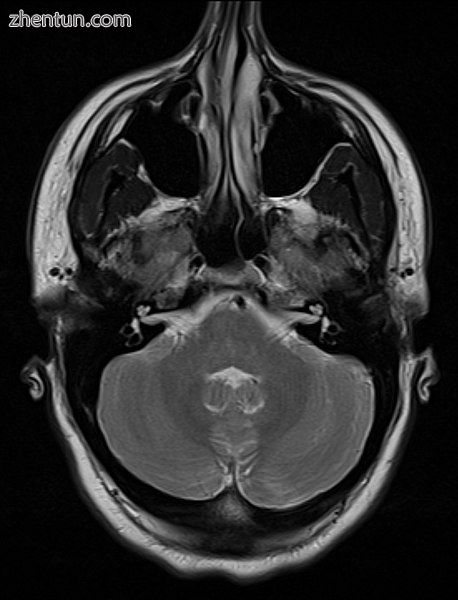 An MRI image showing a congenitally deviated nasal septum.jpg
