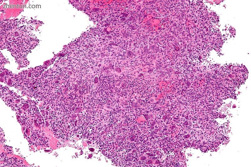 Intermediate magnification micrograph of an aneurysmal bone cyst.jpg