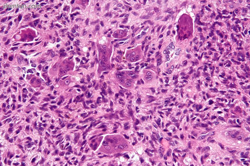 Micrograph of an aneurysmal bone cyst. H&amp;E stain..jpg