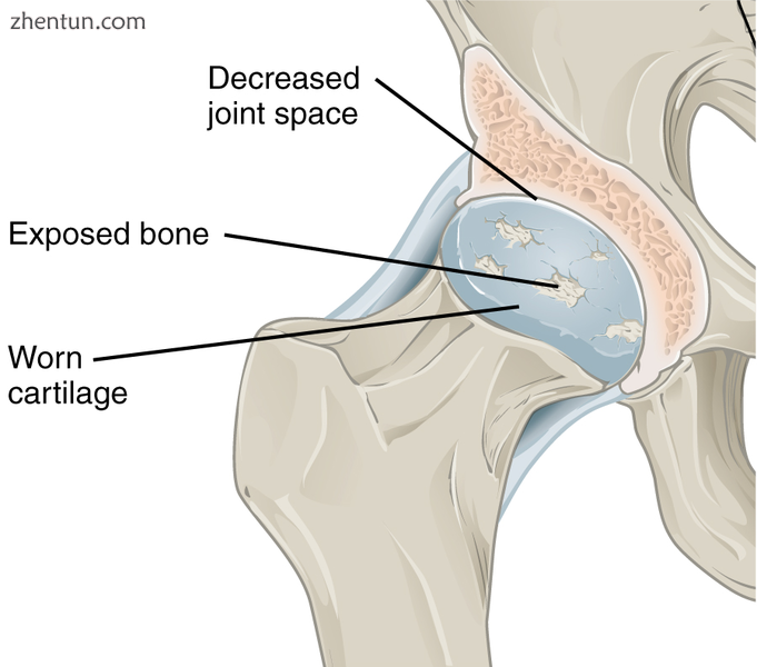 Hip joint with osteoarthritis[32].png
