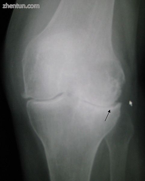 Primary osteoarthritis of the left knee. Note the osteophytes, narrowing of the .jpg