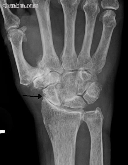 Severe osteoarthritis and osteopenia of the carpal joint and 1st carpometacarpal.jpg