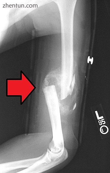 Bone healing of a fracture by forming a callus as shown by X-ray..jpg