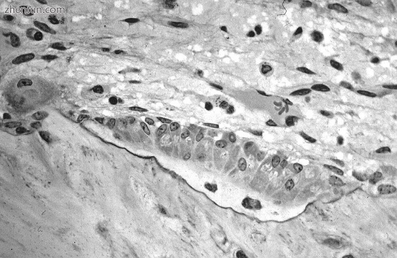 Osteoblasts forming compact bone, containing two osteocytes, within a resorption.jpg