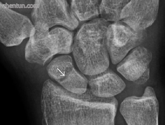 Radiolucency around a 12 day old scaphoid fracture that was initially barely vis.jpg