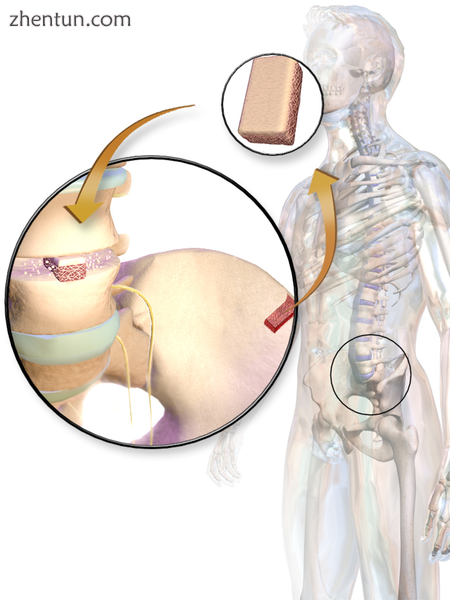 Illustration of an autograft harvested from iliac crest..png