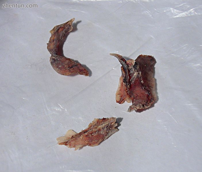 Pieces removed from nasal cavities during septoplasty.JPG