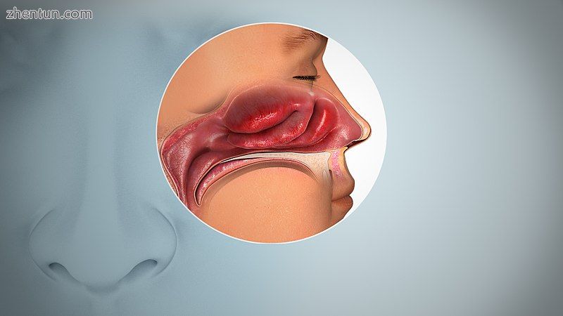 Inflamed nasal mucosa causing anosmia.jpg
