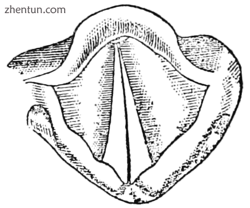 Closed vocal cords as seen during a VCD episode (or when speaking).png