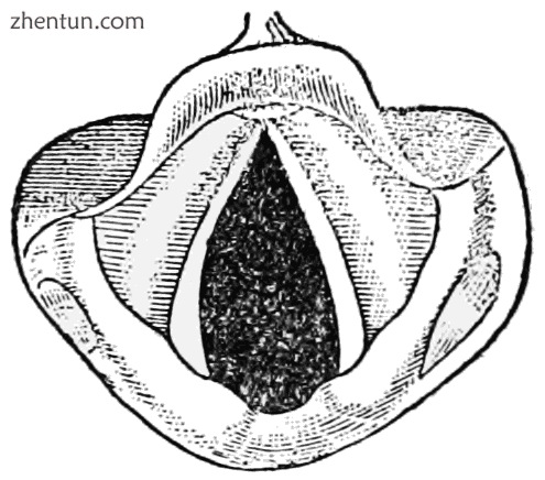 Open vocal cords as seen during normal inhalation.png