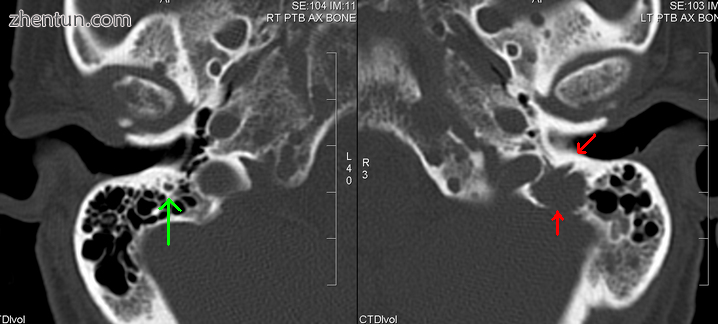 A CT of the brain revealed a lytic lesion in the left temporal bone (r.PNG