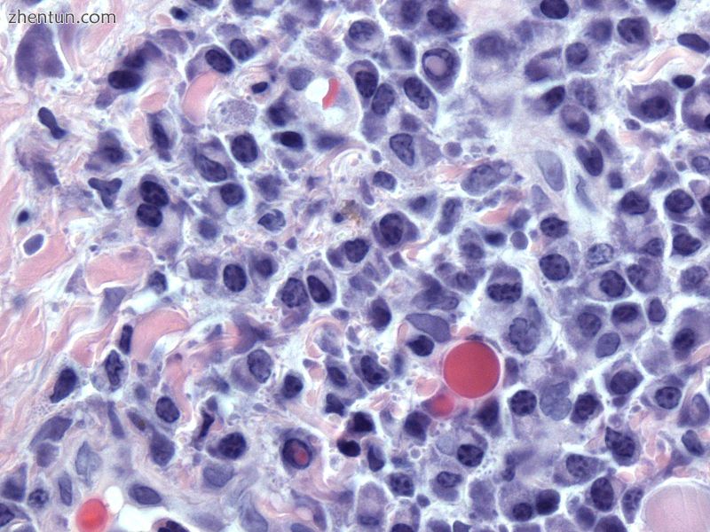 Atypical plasma cell infiltrate with both Russell (cytoplasmic) and Dutcher (nuc.jpg