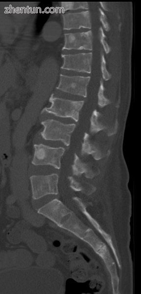 CT scan of the lower vertebral column in a man with multiple myeloma,.jpg