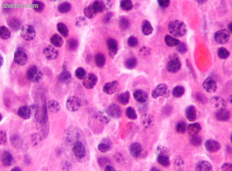 Micrograph of a plasmacytoma. H&amp;E stain.jpg