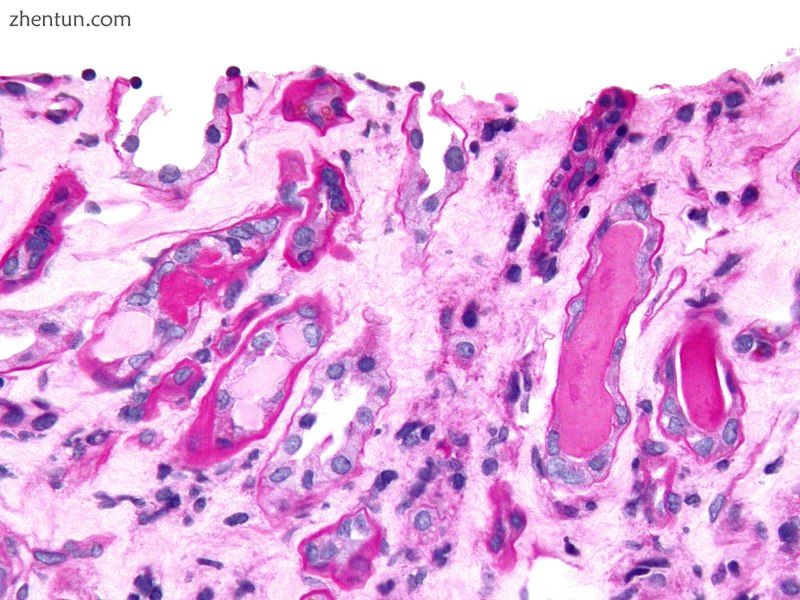 Micrograph showing myeloma cast nephropathy in a kidney biopsy..jpg