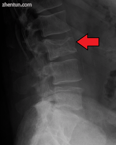 Pathological fracture of the lumbar spine due to multiple myeloma.png