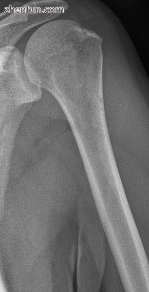 Same humerus before, with just subtle lesions.jpg