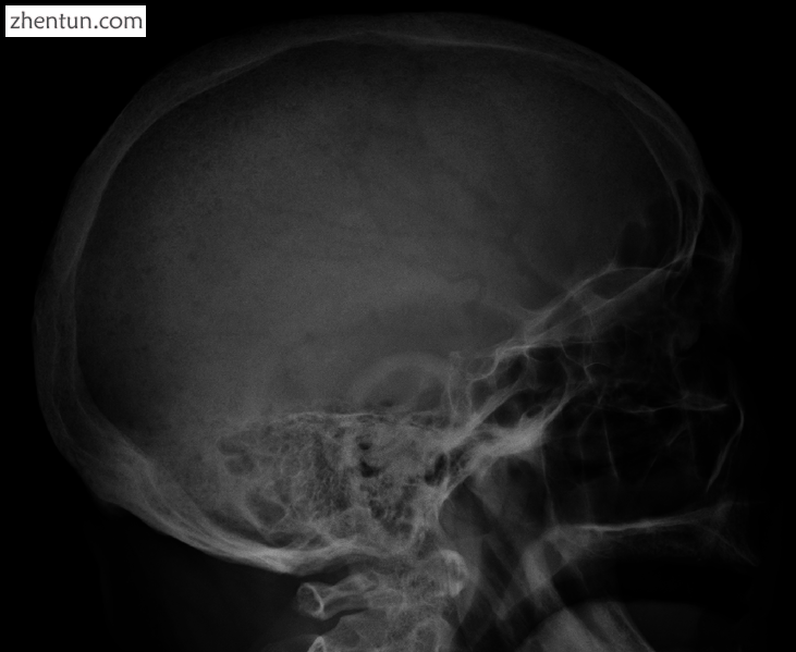 Skull X-ray showing multiple lucencies due to multiple myeloma.png