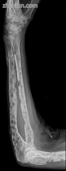 X-ray of the forearm, with lytic lesions..png