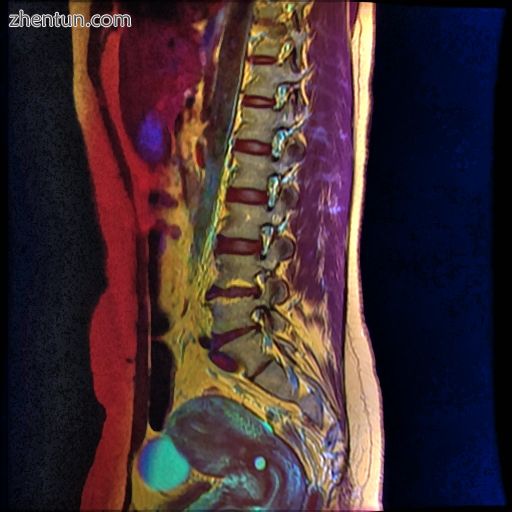 Color MRI showing Nabothian cyst as small blue circle in cervical region..jpg