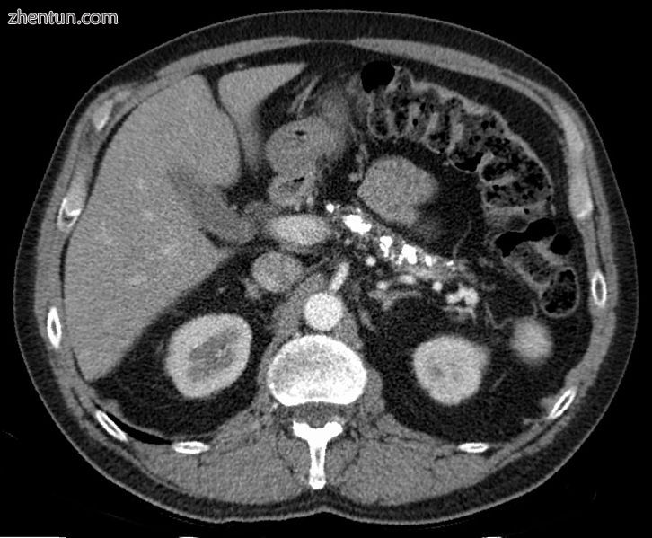 Axial CT showing multiple calcifications in the pancreas in a patient with chron.jpg