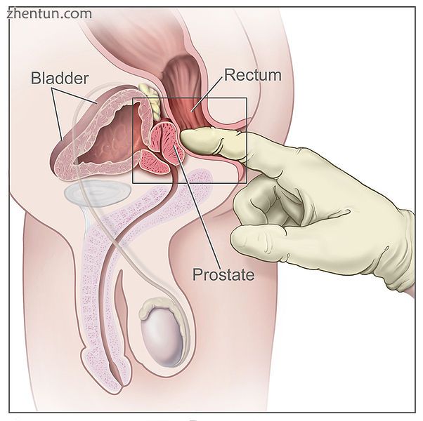 Digital rectal examinations can establish how inflamed a prostate is.jpg