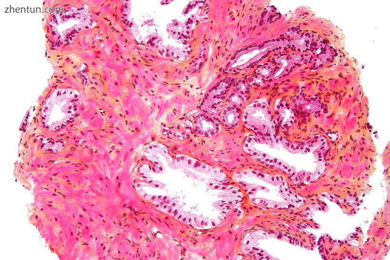 Micrograph showing normal prostatic glands and glands of prostate cancer (prosta.jpg