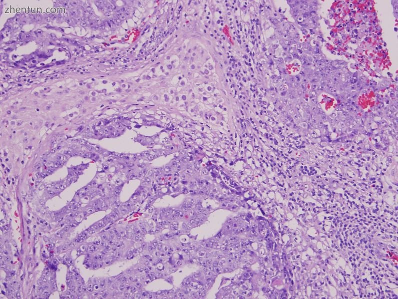 Mixed Germ Cell Tumorcontaining embryonal carcinoma,.jpg
