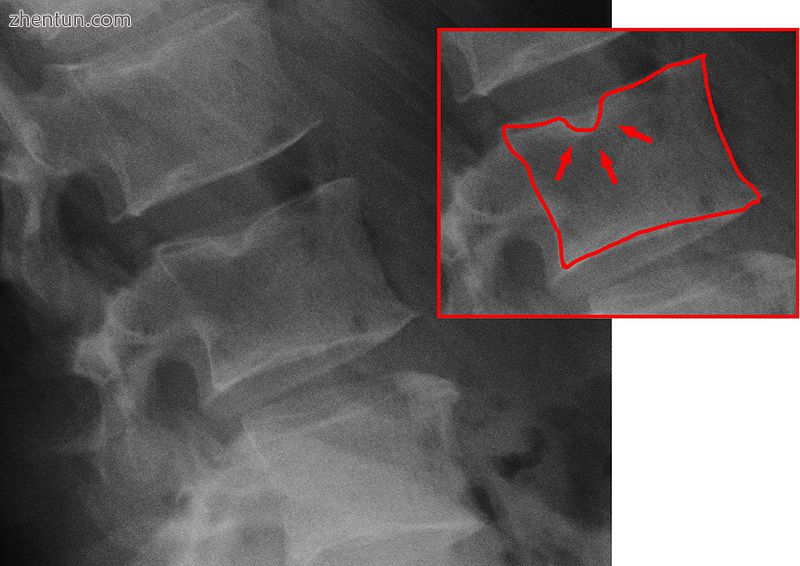 X-ray image of Schmorl's nodes in the lumbar spine.jpg