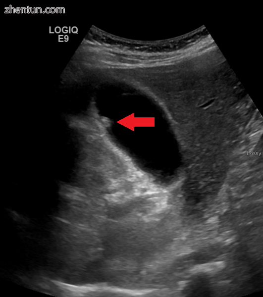 A polyp in the gall bladder as seen on ultrasound.png