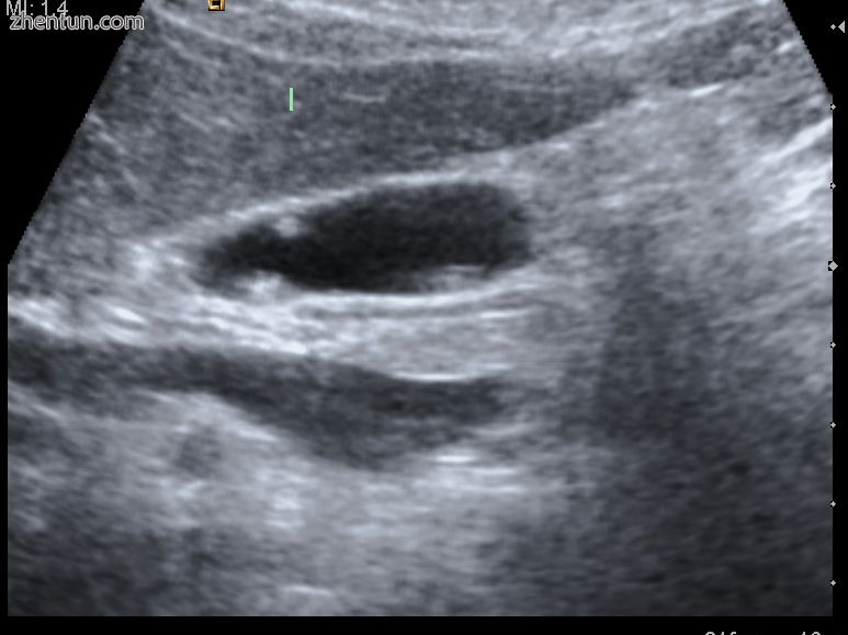 Ultrasound image of gallbladder polyps measuring 3-7mm..jpg