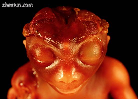 A front view of an anencephalic fetus.jpg