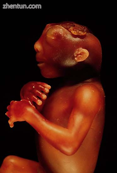A side view of an anencephalic fetus.jpg
