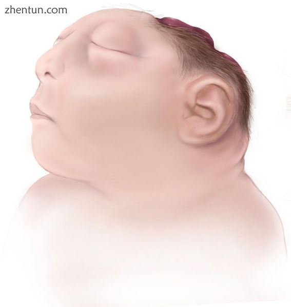 Illustration of an anencephalic fetus..jpg