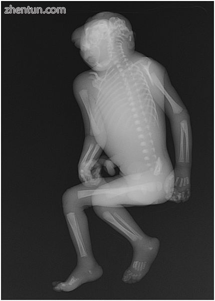 X-ray of an anencephalic stillborn fetus.jpg