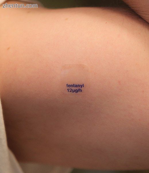A fentanyl transdermal patch with a release rate of 12 micrograms  hour, on a pe.jpg