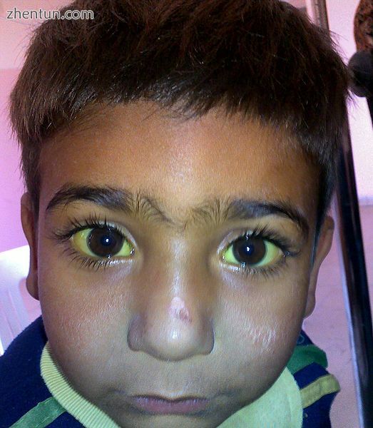 4-year-old boy with jaundiced (yellowish) scleras that later proved to be a mani.jpg