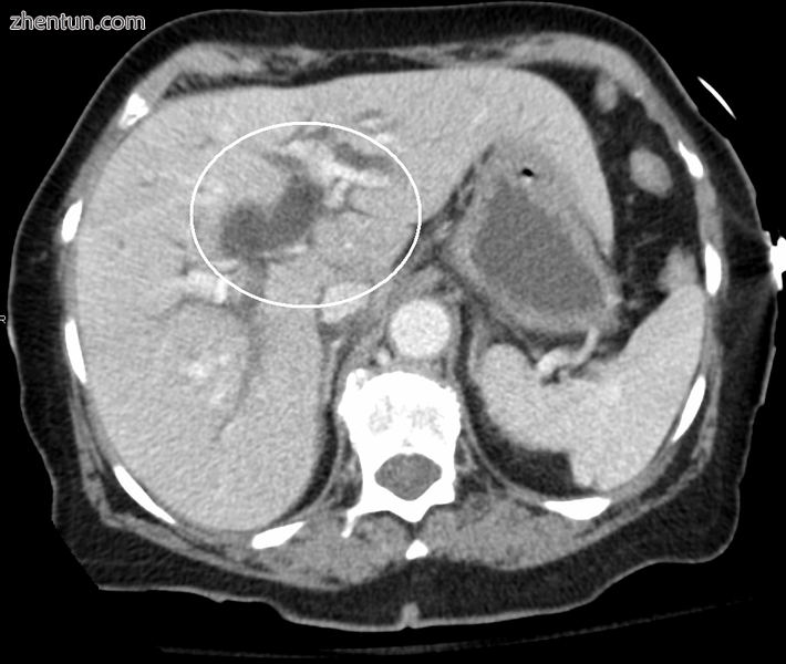 Biliary tract dilation due to obstruction.png