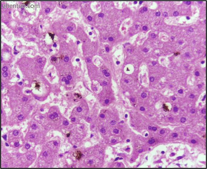 Microscopy of cholestatic liver showing bilirubin pigment, H&amp;E stain.jpg
