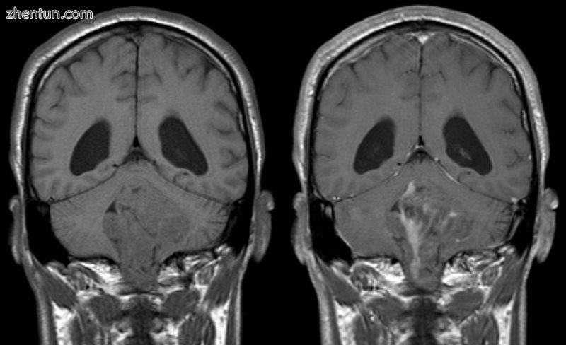 Ependymoma of 4.ventricle in MRI. Left without, right with contrast-enhancement..jpg