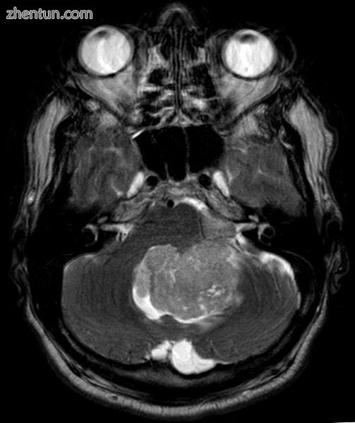 Ependymoma of 4.ventricle in MRI.1.jpg