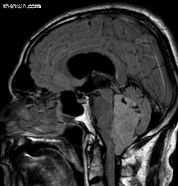 Ependymoma of 4.ventricle in MRI.2.jpg