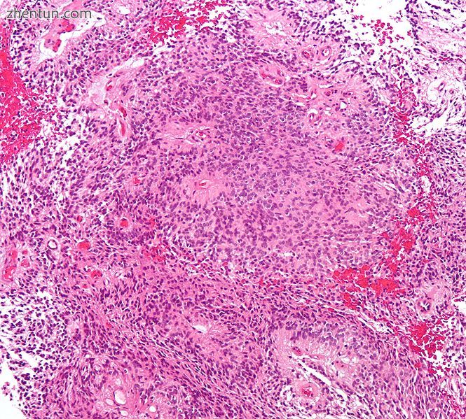Micrograph of an ependymoma. H&amp;E stain..jpg