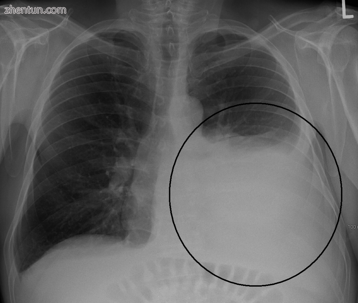 A large left sided pleural effusion as seen on an upright chest X-ray.PNG