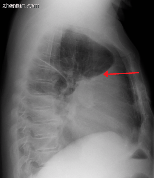 A pleural effusion as seen on lateral upright chest x ray.png