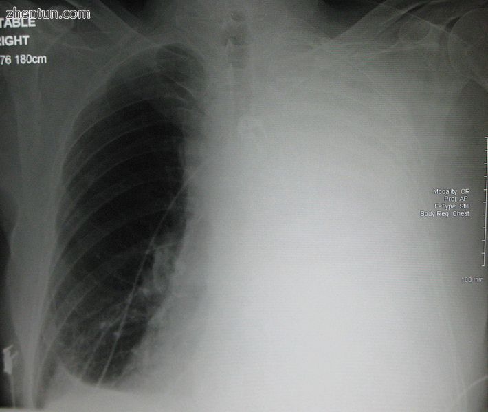 Massive left-sided pleural effusion (whiteness) in a patient presenting with lun.jpg