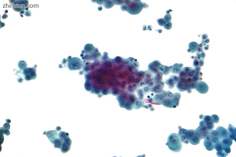Micrograph of a pleural fluid cytopathology specimen showing malignant mesotheli.jpg